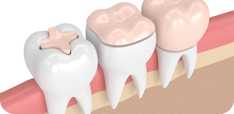 Reconstruction des dents