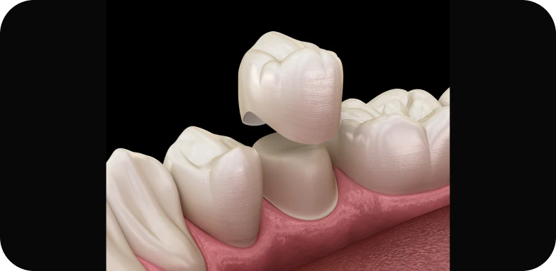 Reconstruction des dents