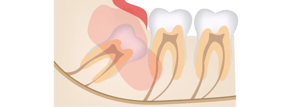 Dégagement des dents incluses au Cabinet Dentaire du Léman à Mies