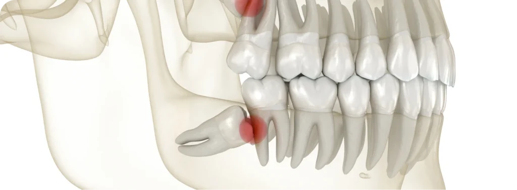 Extraction des dents de sagesse